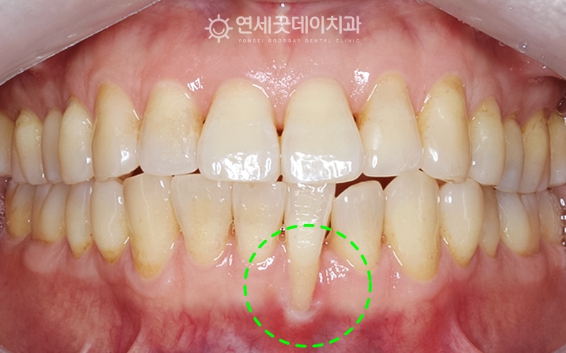 핀홀과 아랫니부분교정 치료전 모습이며 치주교정 시행키로 하였음