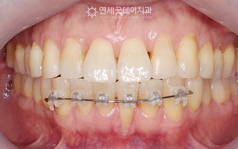 치주교정 단계 중 아랫니부분교정 먼저 진행중인 모습
