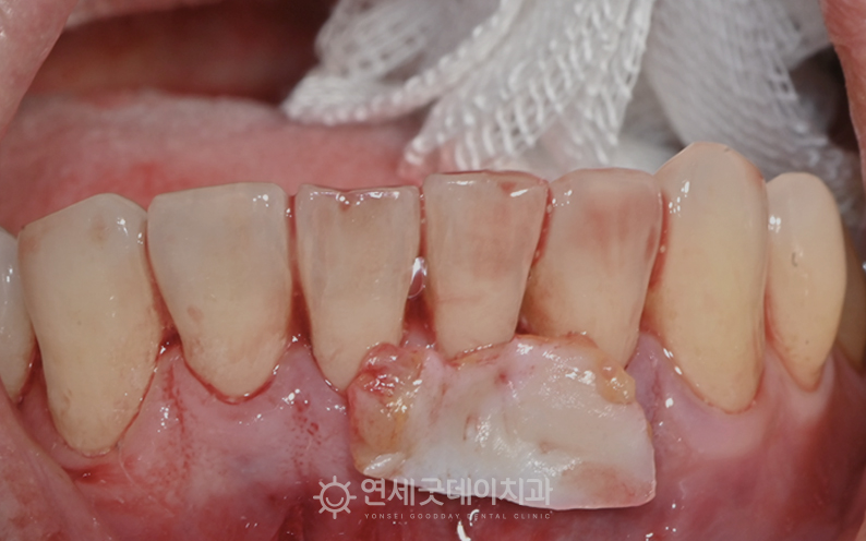 아랫니부분교정 종료 후 핀홀 수술을 통해 치주교정 진행