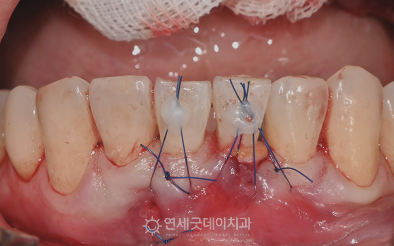 치주교정 과정 중 핀홀수술 모습