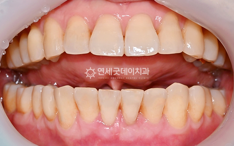 핀홀과 아랫니부분교정을 동반한 치주교정 종결 후 구내모습