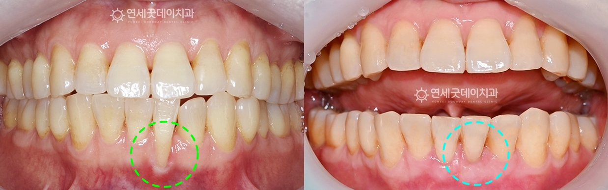 핀홀 및 아랫니부분교정 (치주교정) 치료전후 구내모습