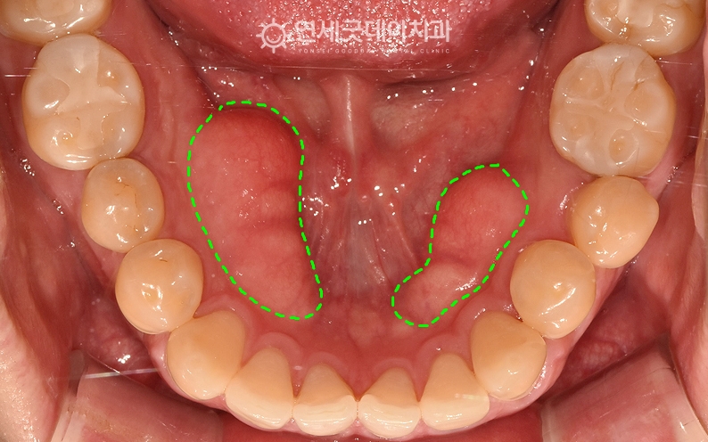 하악골융기, 토러스로 인해 치조골성형술 희망 - 치료전 모습