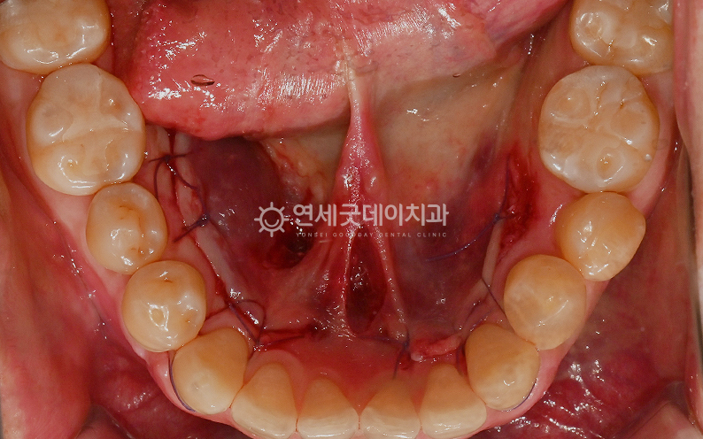 하악골융기 토러스 제거 직후 모습