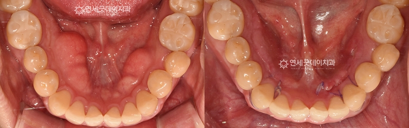 치조골성형술을 통한 하악골융기 제거 치료 전후 비교모습
