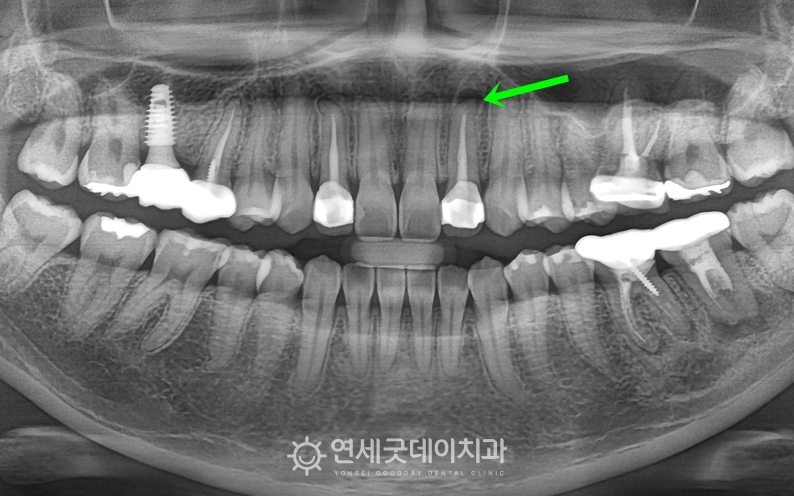재신경차료 전 치근단에 염증이 관찰되는 모습