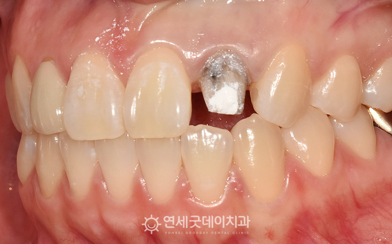 실활치미백 전 어둡게 변한 치아