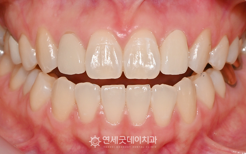 재신경치료 및 실활치미백 종료