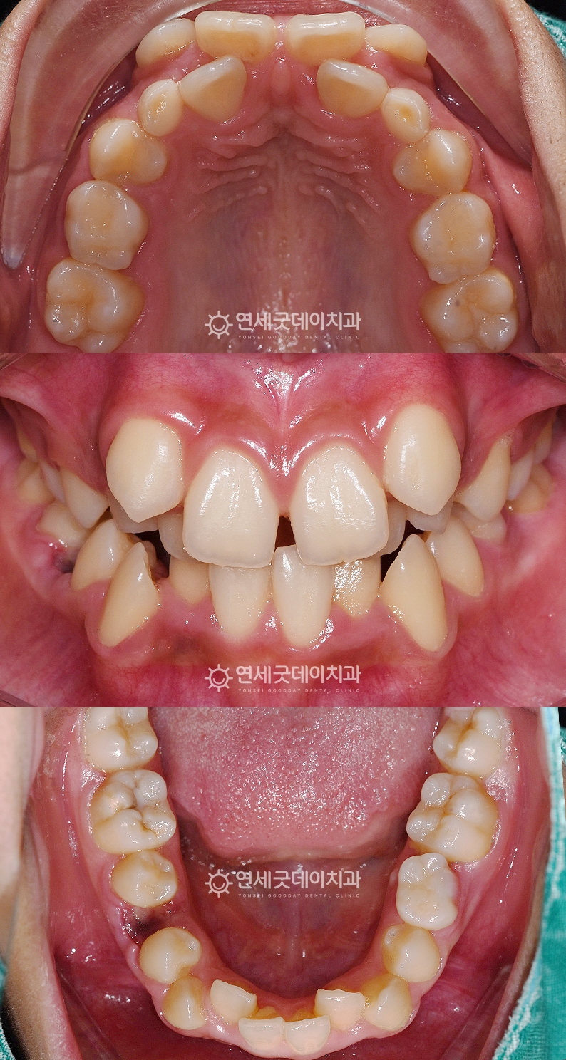 심한 뻐드렁니로 송곳니교정 치료계획 수립