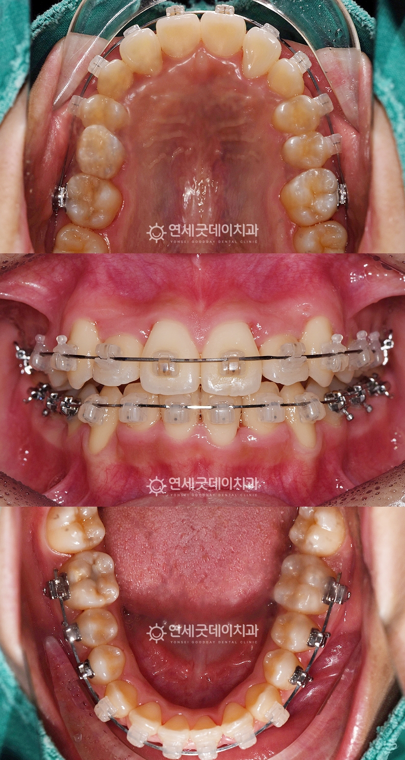 송곳니교정 진행 중 - 뻐드렁니가 재배열된 모습