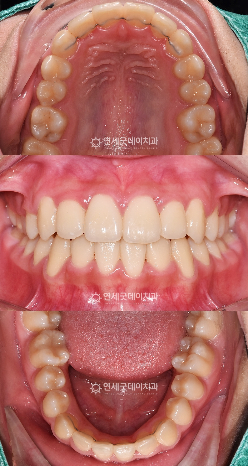 뻐드렁니 송곳나교정 종료 후 구내모습