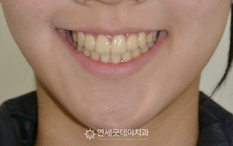 송곳니교정 후 뻐드렁니 없이 심미적으로 개선됨