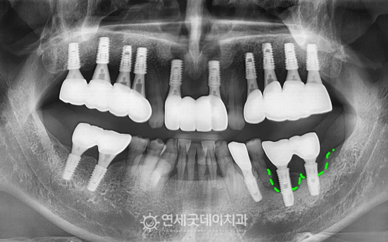임플란트 재수술 전 심한 치조골소실이 관찰됨