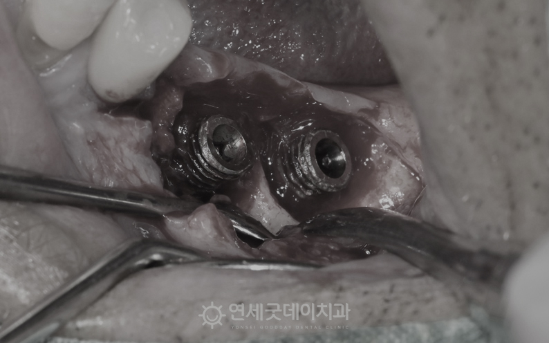 임플란트 재수술 과정 ① - 타원 임플란트 제거