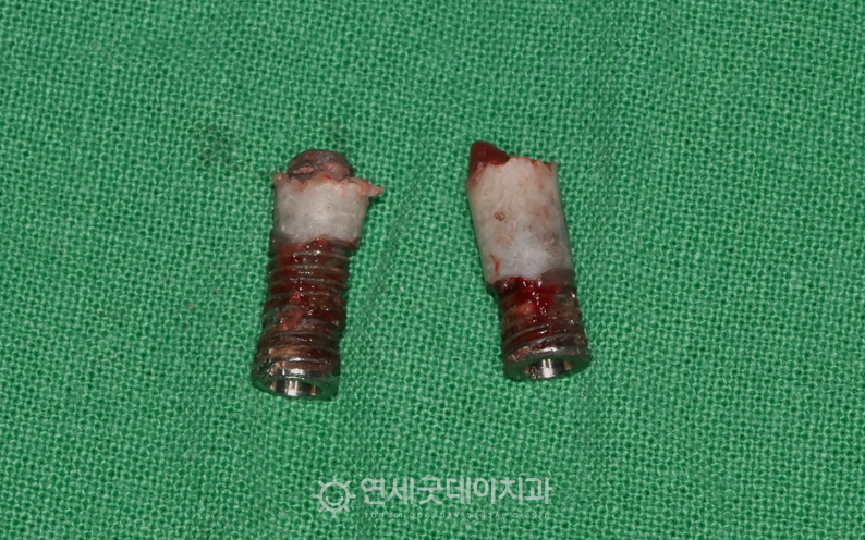 임플란트 재수술 과정 ① - 제거한 임플란트 모습