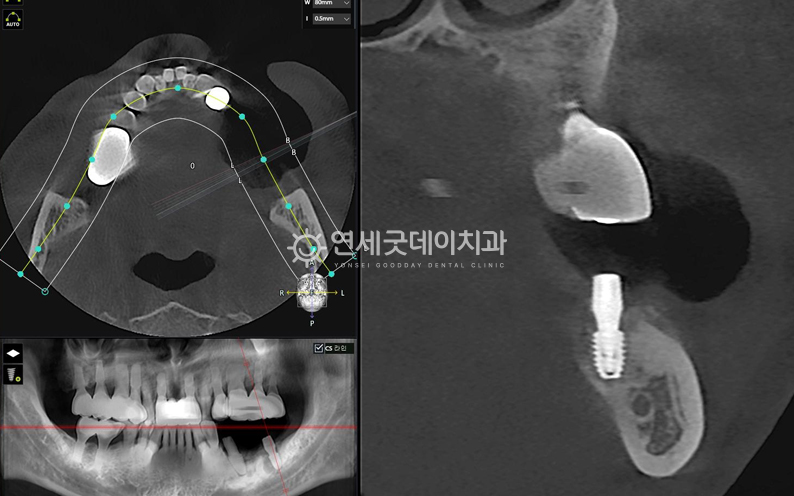 임플란트 재수술 과정 ② - 임플란트 재수술 전 정밀진단 과정