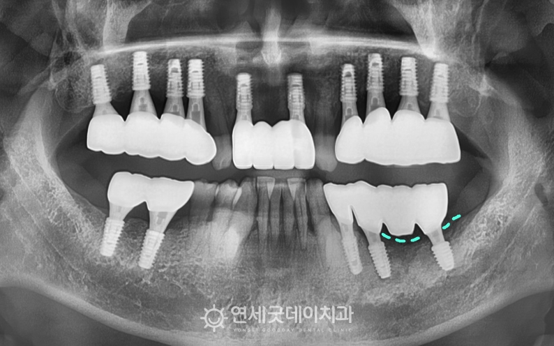 임플란트 재수술 종료 후 잇몸뼈 재생 및 임플란트가 안정적으로 식립된 모습