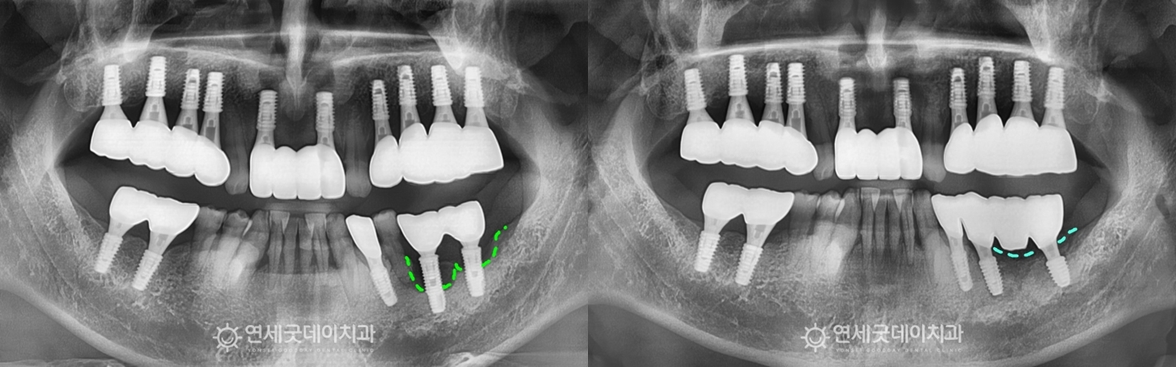 임플란트 재수술 전과 후 비교 (엑스레이)