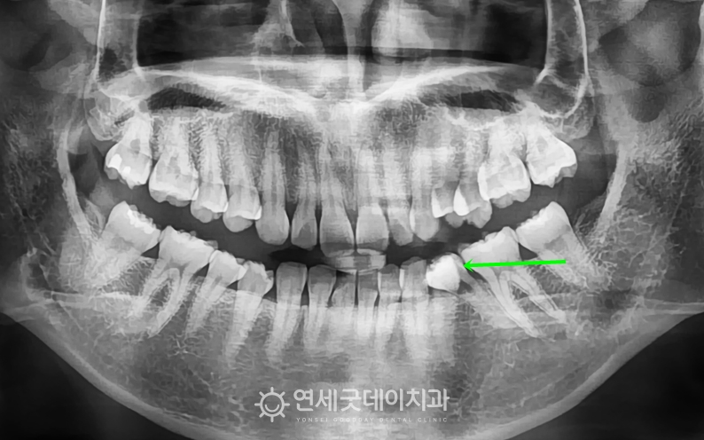 과개교합 및 거미스마일 교정 전 x-ray