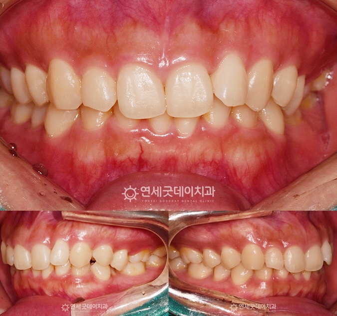 심한 과개교합으로 아랫니가 보이지 않는 모습