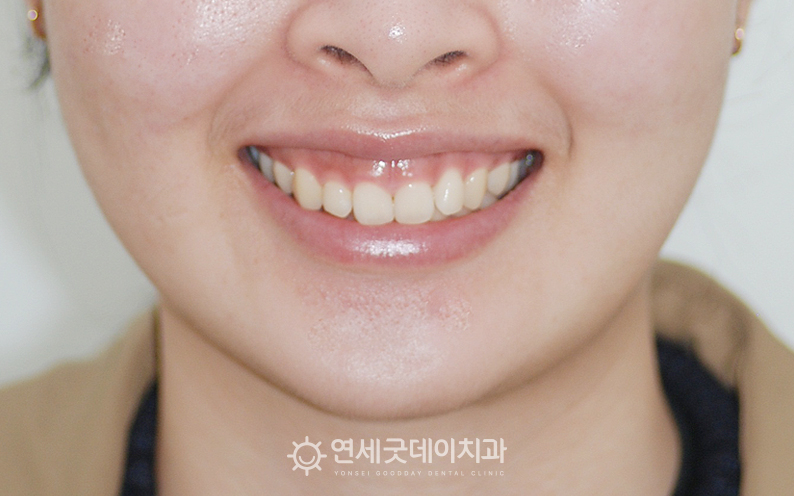 과개교합 교정 전, 거미스마일로 인해 윗 잇몸이 많이 드러남
