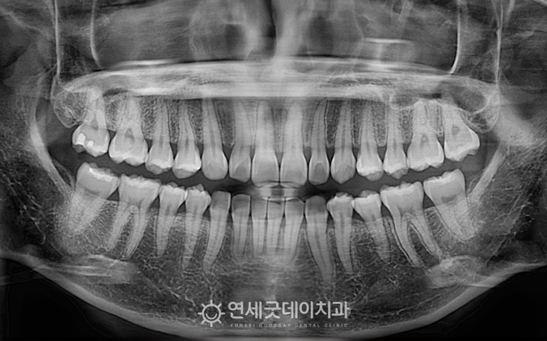 과개교합 및 거미스마일 교정 후 x-ray