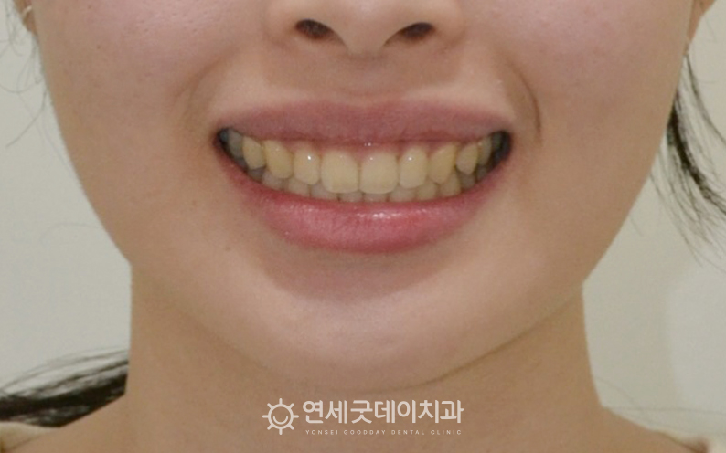 과개교합 교정을 통해 거미스마일 해소