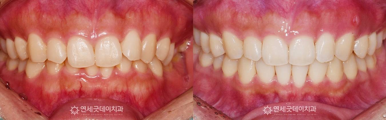 과개교합, 거미스마일 치료전후 (구내)