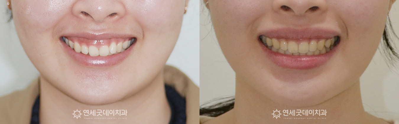 과개교합, 거미스마일 치료전후 (안모)