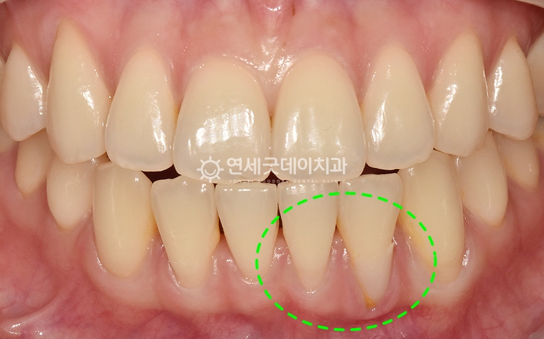 내려앉은잇몸으로 인해 잇몸이식 희망