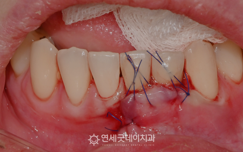 내려앉은부위에 잇몸이식 후 봉합한 모습