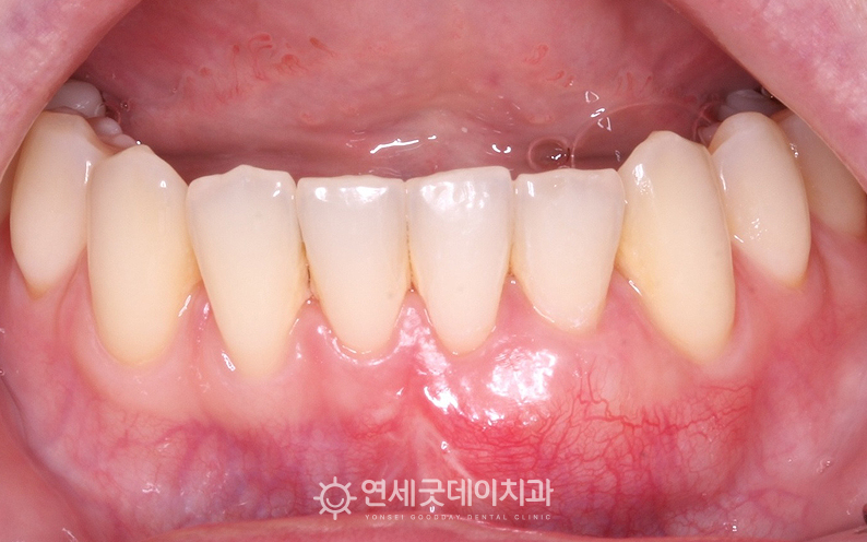 잇몸이식 후 2주가 지났으며 내려앉은잇몸이 보완됨