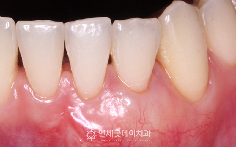 내려앉은잇몸 부위에 잇몸이식 후 한달이 지난 모습
