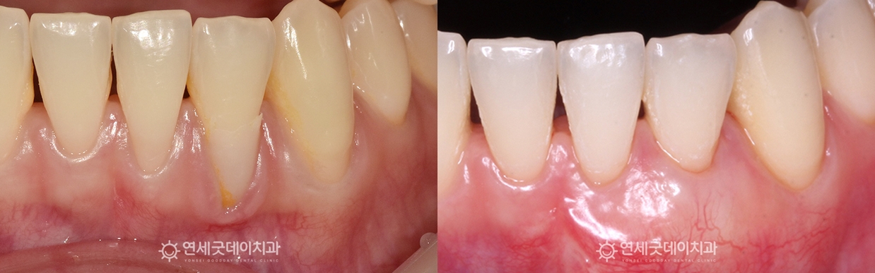 내려앉은잇몸 잇몸이식 치료전후 구내 모습