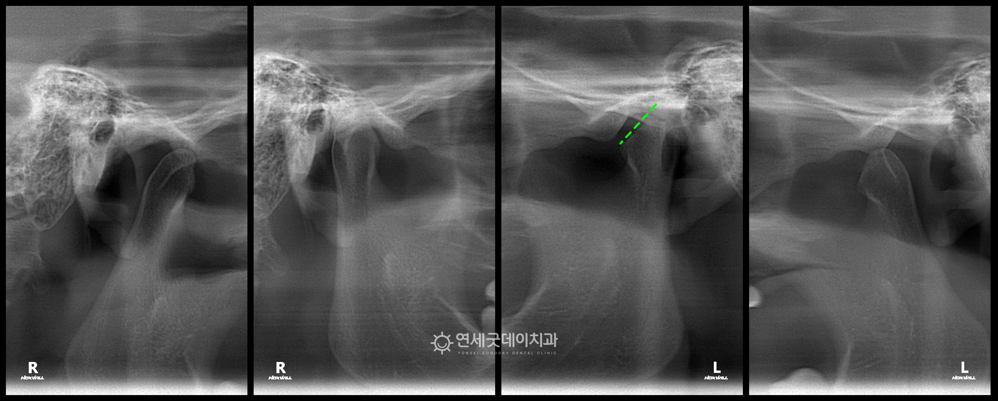 턱관절 방사선을 통해 턱관절교정이 필요한 것을 확인하였음