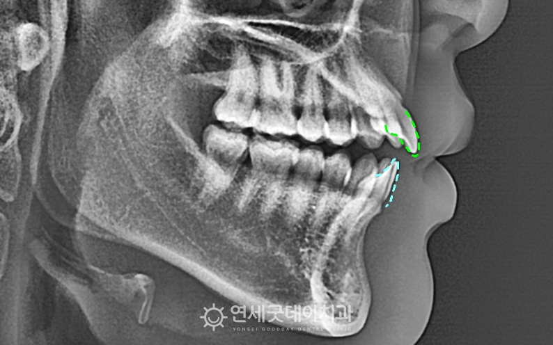 턱관절교정 후 숨어있던 개방교합 드러남 - 개방교합 교정 전 모습