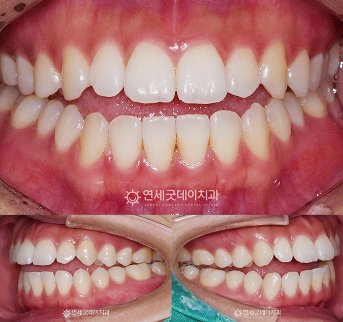 개방교합 교정 전 구내포토