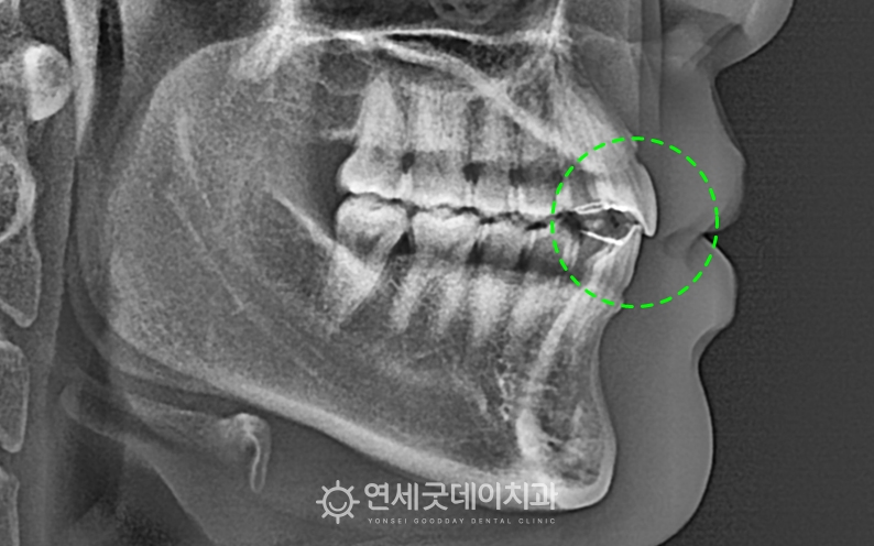 턱관절교정 및 개방교합 교정 후 엑스레이
