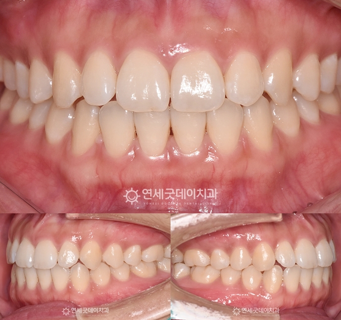 턱관절교정 및 개방교합 교정 후 교합이 안정화 된 모습