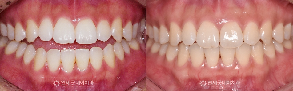 턱관절교정 치료전후 (구내모습 비교)