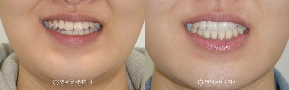 턱관절교정 치료전후 (안모 비교)