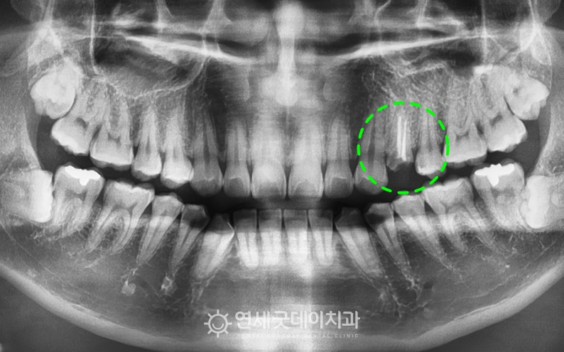 치아파절로 재신경치료 전 엑스레이