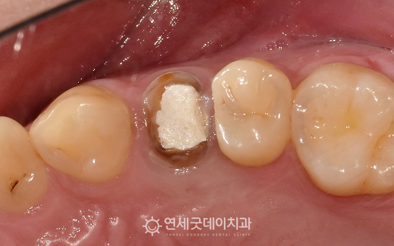 심한 치아파절로 재신경치료 후 PFM 크라운 치료계획 수립