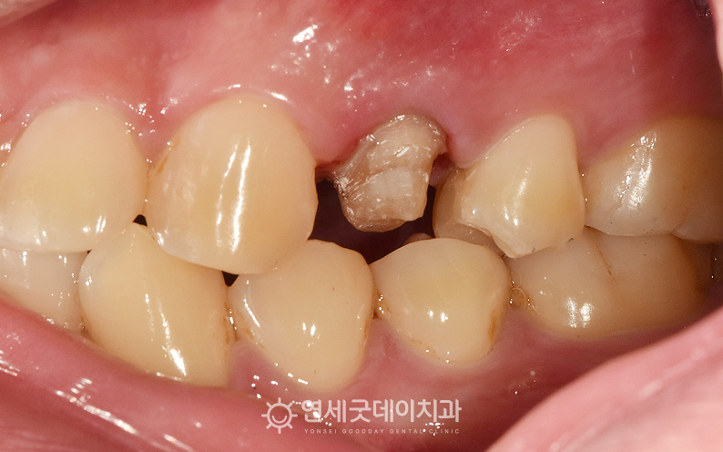 재신경치료 후 치아를 보강한 모습 (1)