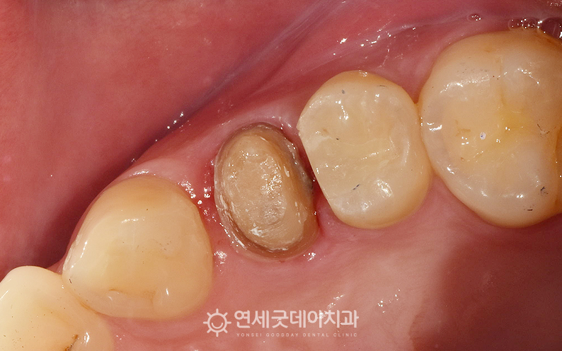 재신경치료 후 치아를 보강한 모습 (2)