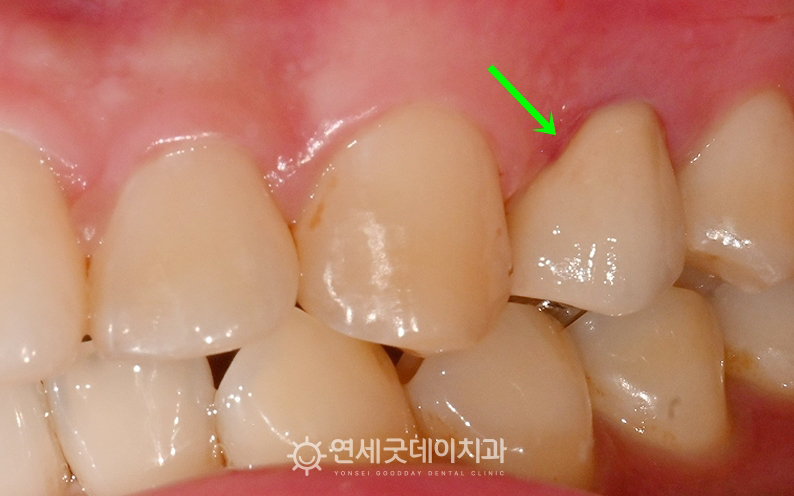 PFM크라운 씌운 구내 모습