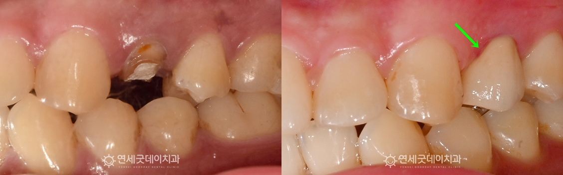 치아파절 재신경치료 전후 구내모습 비교
