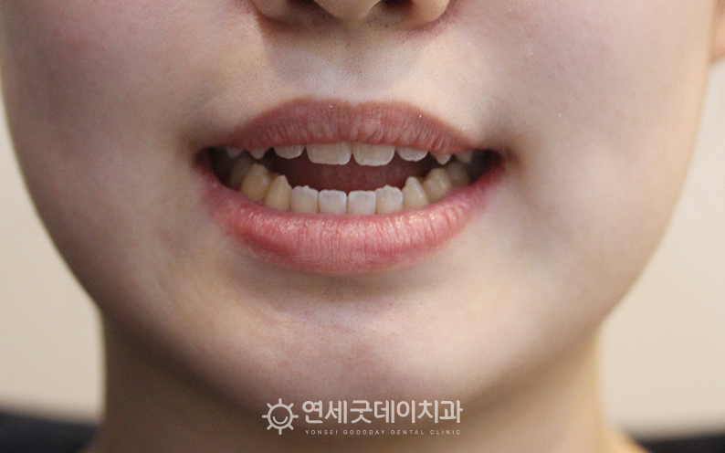 개방교합 재교정 치료전으로, 상하악이 떠있는 모습