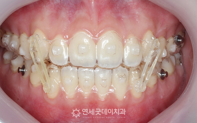 인비절라인을 이용해 개방교합 재교정 진행 중인 모습