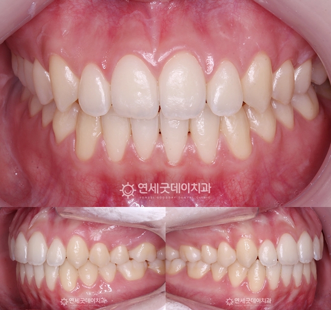 인비절라인을 이용한 개방교합 재교정 치료종료